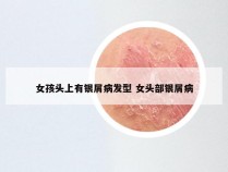 女孩头上有银屑病发型 女头部银屑病