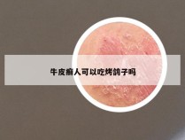 牛皮癣人可以吃烤鸽子吗