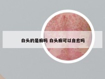 白头的是癣吗 白头癣可以自愈吗