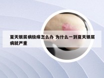 夏天银屑病极痒怎么办 为什么一到夏天银屑病就严重