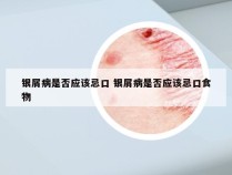 银屑病是否应该忌口 银屑病是否应该忌口食物
