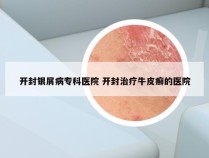 开封银屑病专科医院 开封治疗牛皮癣的医院
