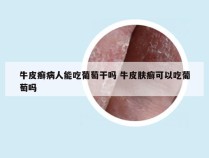 牛皮癣病人能吃葡萄干吗 牛皮肤癣可以吃葡萄吗