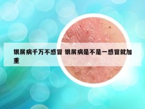 银屑病千万不感冒 银屑病是不是一感冒就加重