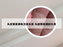 头皮银屑病每次掉头屑 头部银屑病掉头发