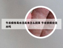 牛皮癣有毒水流出来怎么回事 牛皮肤癣会流水吗