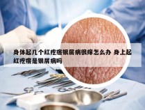 身体起几个红疙瘩银屑病很痒怎么办 身上起红疙瘩是银屑病吗