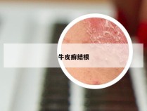 牛皮癣结根