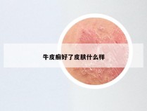 牛皮癣好了皮肤什么样