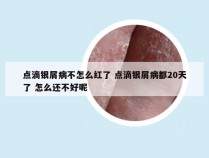 点滴银屑病不怎么红了 点滴银屑病都20天了 怎么还不好呢