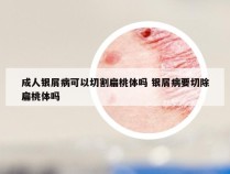 成人银屑病可以切割扁桃体吗 银屑病要切除扁桃体吗