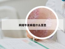 网络牛皮癣是什么意思