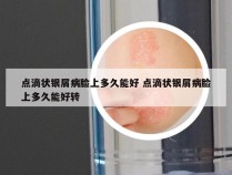 点滴状银屑病脸上多久能好 点滴状银屑病脸上多久能好转