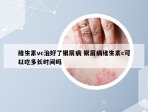 维生素vc治好了银屑病 银屑病维生素c可以吃多长时间吗