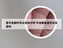 患牛皮癣时可以生孩子吗 牛皮癣患者可以生育吗