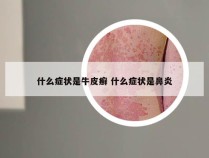 什么症状是牛皮癣 什么症状是鼻炎