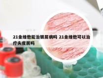21金维他能治银屑病吗 21金维他可以治疗头皮屑吗