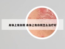 身体上有白斑 身体上有白斑怎么治疗好