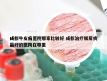 成都牛皮癣医院那家比较好 成都治疗银屑病最好的医院在哪里