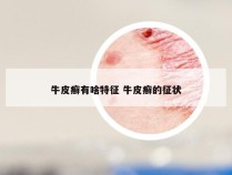 牛皮癣有啥特征 牛皮癣的征状