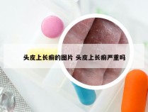 头皮上长癣的图片 头皮上长癣严重吗