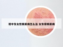 初中生女性银屑病怎么治 女生得银屑病