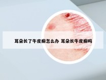 耳朵长了牛皮癣怎么办 耳朵长牛皮癣吗