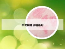 牛皮癣几点睡最好