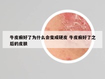 牛皮癣好了为什么会变成硬皮 牛皮癣好了之后的皮肤