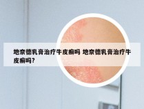 地奈德乳膏治疗牛皮癣吗 地奈德乳膏治疗牛皮癣吗?