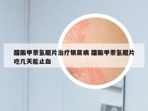 醋酸甲萘氢醌片治疗银屑病 醋酸甲萘氢醌片吃几天能止血