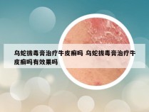 乌蛇拔毒膏治疗牛皮癣吗 乌蛇拔毒膏治疗牛皮癣吗有效果吗