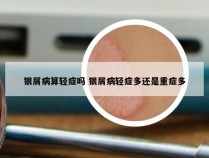 银屑病算轻症吗 银屑病轻症多还是重症多