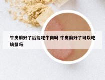 牛皮癣好了后能吃牛肉吗 牛皮癣好了可以吃螃蟹吗