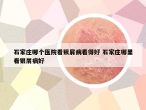 石家庄哪个医院看银屑病看得好 石家庄哪里看银屑病好