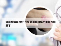 银屑病痒是快好了吗 银屑病瘙痒严重是否加重了