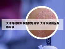 天津好的银屑病医院是哪家 天津银屑病医院哪家强