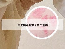 牛皮癣年龄大了更严重吗