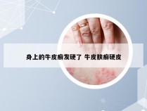 身上的牛皮癣发硬了 牛皮肤癣硬皮