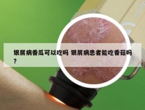 银屑病香瓜可以吃吗 银屑病患者能吃香菇吗?