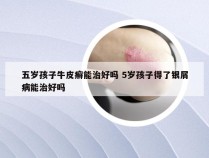 五岁孩子牛皮癣能治好吗 5岁孩子得了银屑病能治好吗
