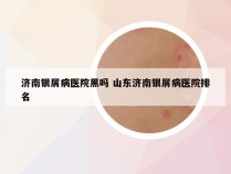 济南银屑病医院黑吗 山东济南银屑病医院排名