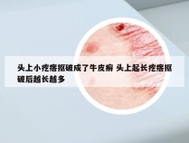头上小疙瘩抠破成了牛皮癣 头上起长疙瘩抠破后越长越多