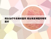 烟台治疗牛皮癣的医院 烟台银屑病医院哪家最好