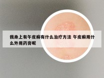 我身上有午皮癣有什么治疗方法 午皮癣用什么外用药膏呢