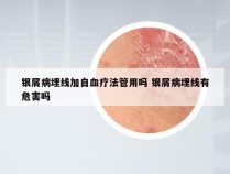 银屑病埋线加自血疗法管用吗 银屑病埋线有危害吗