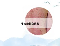 牛皮癣长白头发