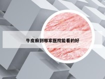 牛皮癣到哪家医院能看的好