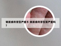 银屑病寻常型严重不 银屑病寻常型算严重吗?