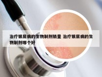 治疗银屑病的生物制剂销量 治疗银屑病的生物制剂哪个好